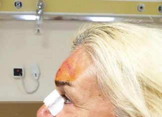 Burçin Orhon, baygınlık geçirirken yüzüstü düştü. Alnında ve burnunda ciddi yaralar oluşan Orhon, yüzünün son halini Instagram hesabından paylaşarak kendisine nazar değdiğini söyledi.